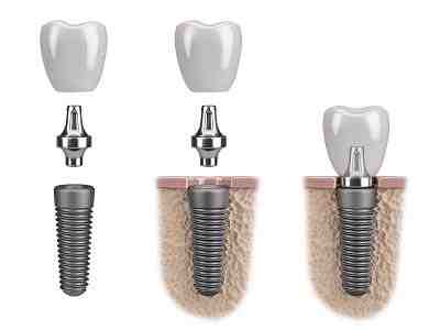 What happens if dental abutment Falls?
