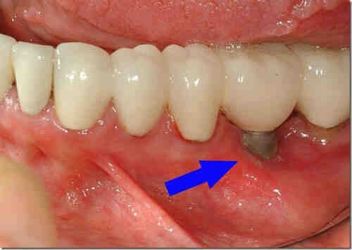 What hurts more tooth extraction or implant?