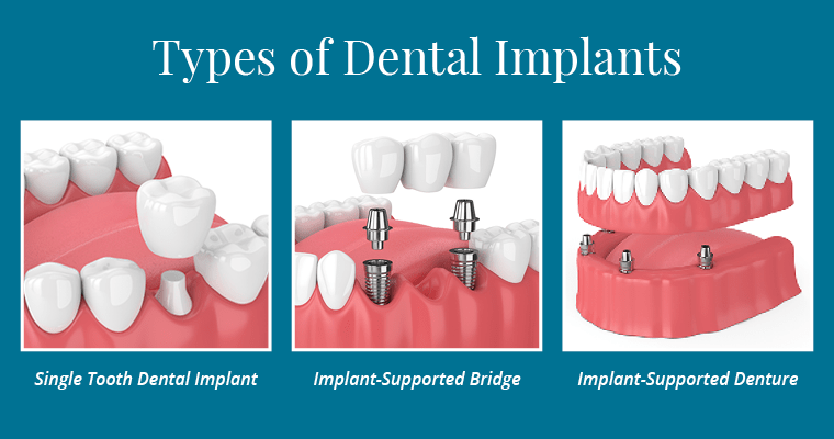 What implant is the most durable?