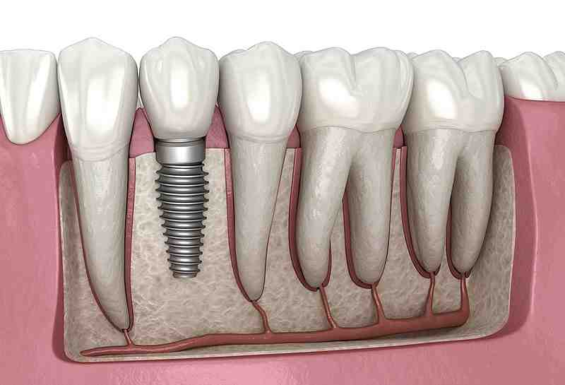 What is Immediate implant placement?