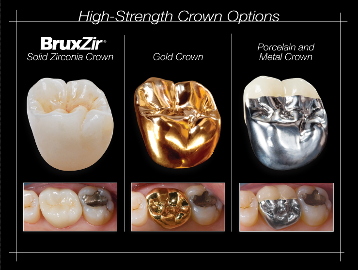 What is a custom dental implant abutment Dental News Network