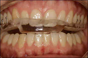 What is considered severe TMJ?