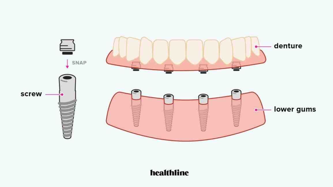 What is more painful tooth extraction or implant?