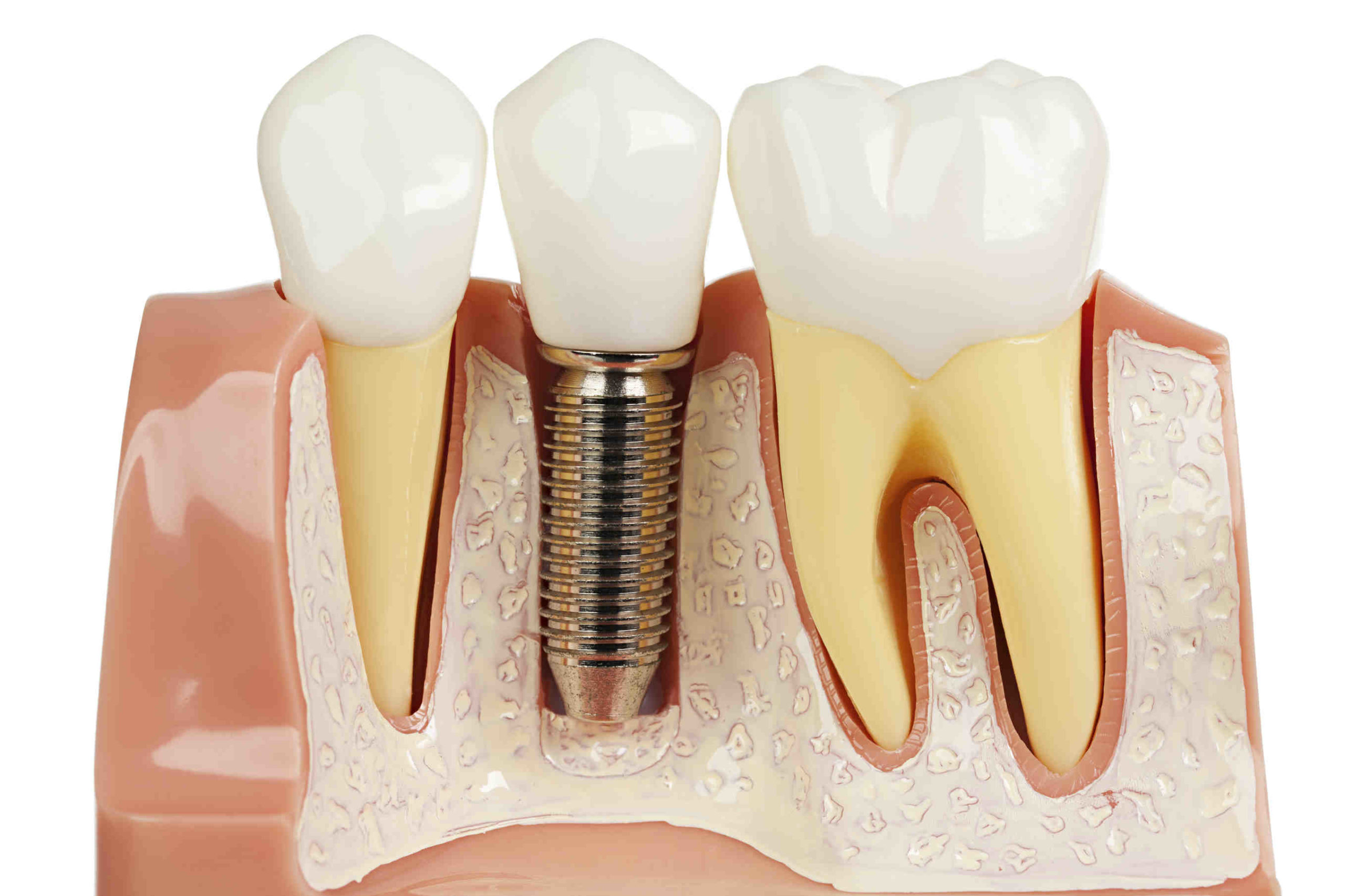 What is primary implant stability?