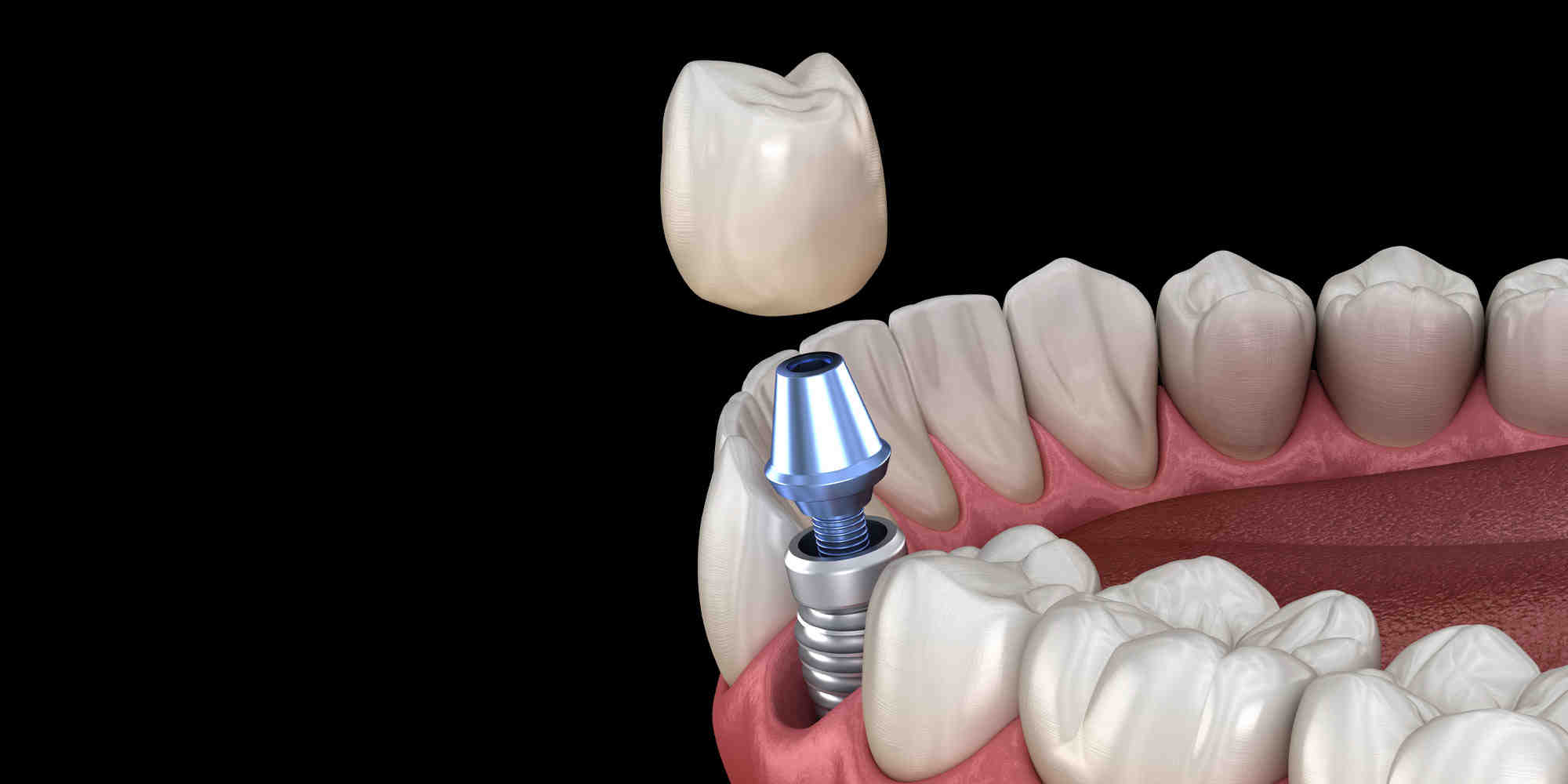 What is snap on smile?