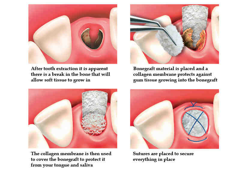 What is the alternative to bone grafting?