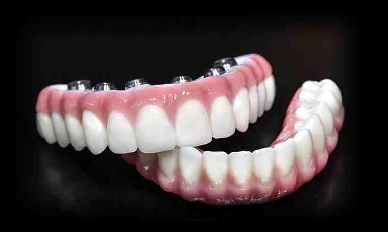What is the best alternative to dental implants?