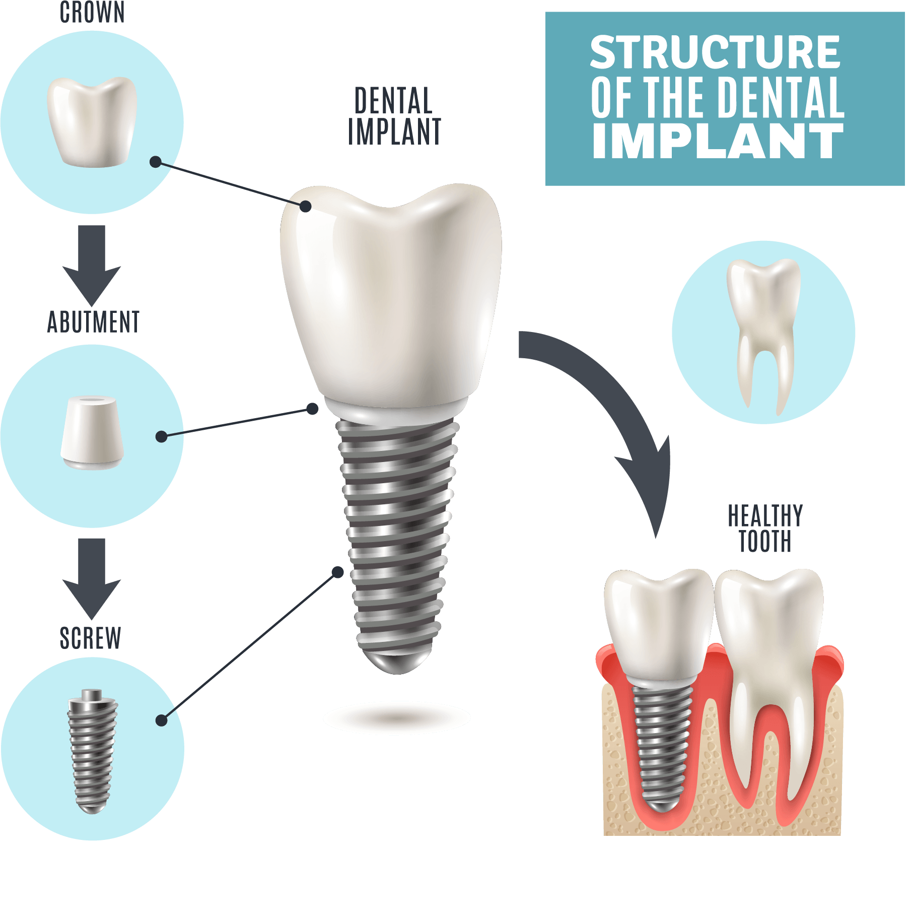 What is the difference between titanium and zirconium implants?