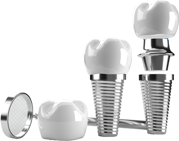What is the downfall to dental implants?