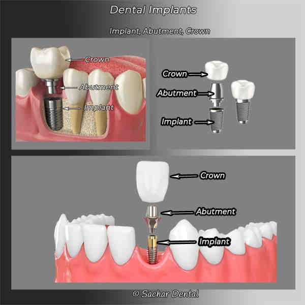 What is the failure rate of dental implants?