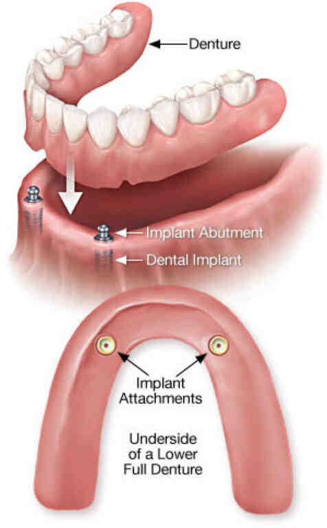 What is the new denture technology?