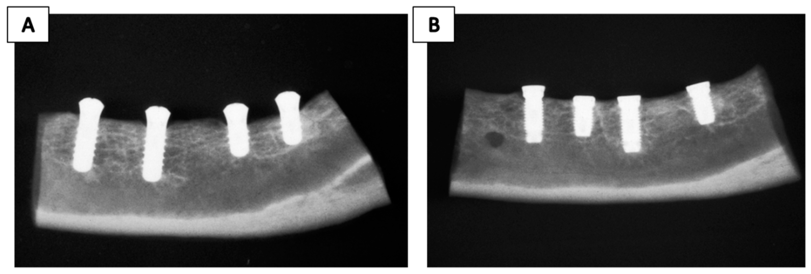 What is the safest tooth implant material?