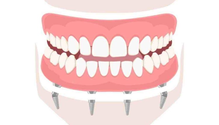 What kind of dental implants does jeffree star have