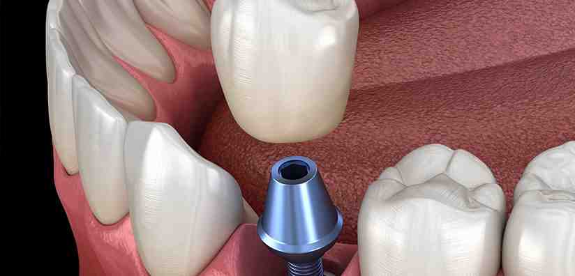 What kind of pain does prostate cancer cause?