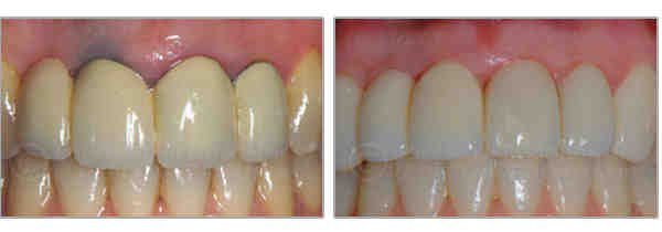 What material is used in dental implants?