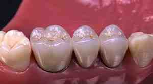 What not to do with teeth implants?