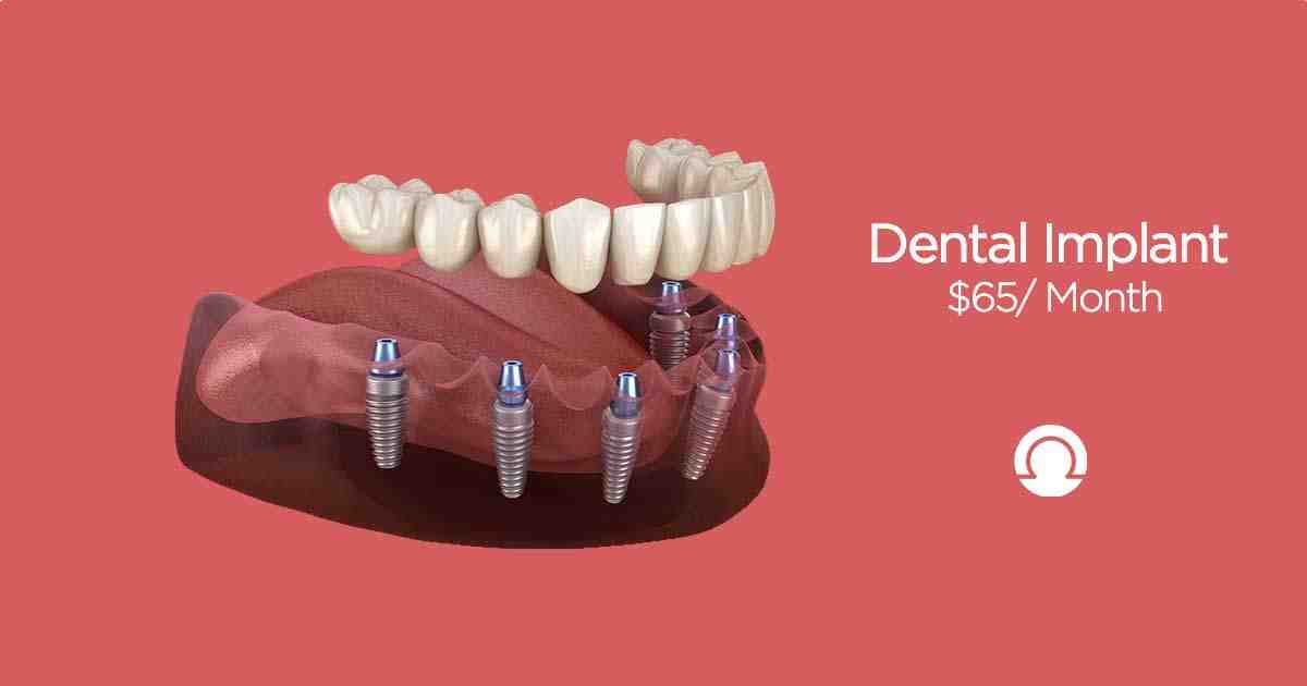 What percentage of tooth implants fail?