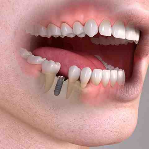 What they don't tell you about dental implants?
