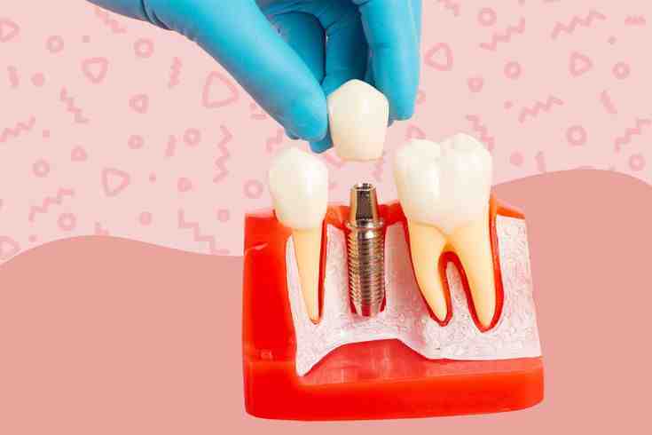 What they don't tell you about dental implants?