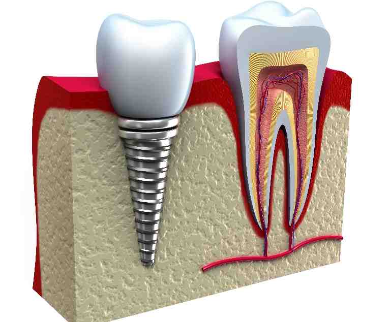 What they don't tell you about dental implants?