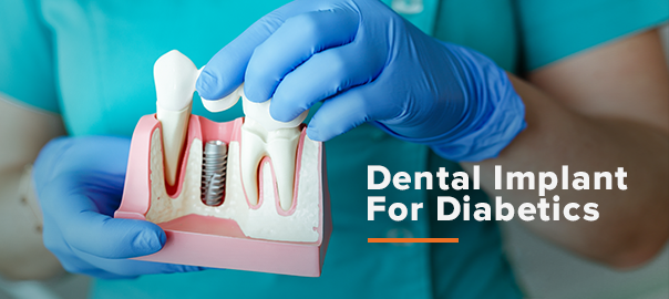 What they don't tell you about dental implants?