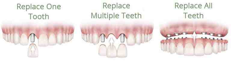 What's the cheapest way to replace your teeth?
