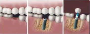When should you not get dental implants?