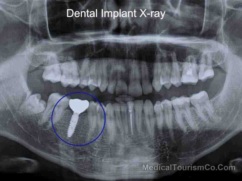 Where is the cheapest place in the world for dental implants?