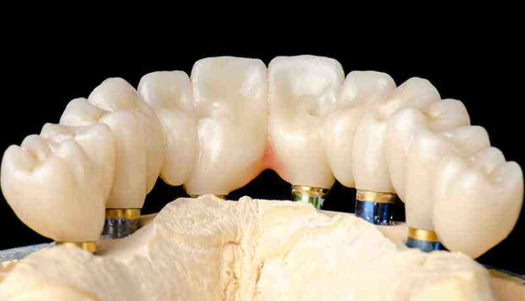 Where to go for dental implant in mexico