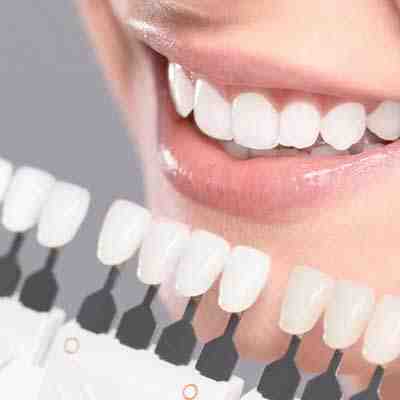 Which dental veneers are the best?
