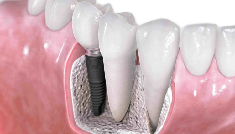 Who is a dentist put dental implants