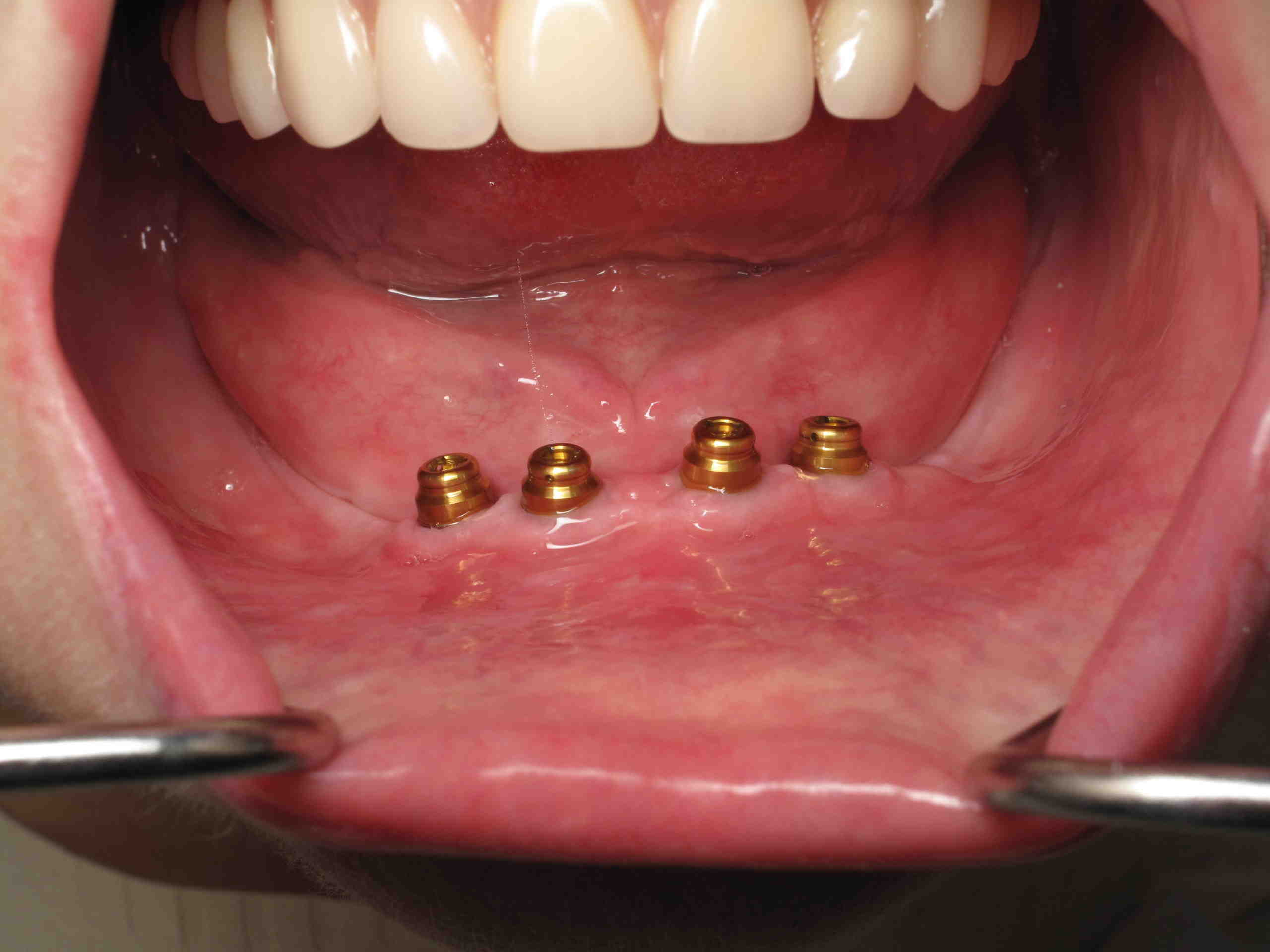 Who is not a candidate for dental implants?