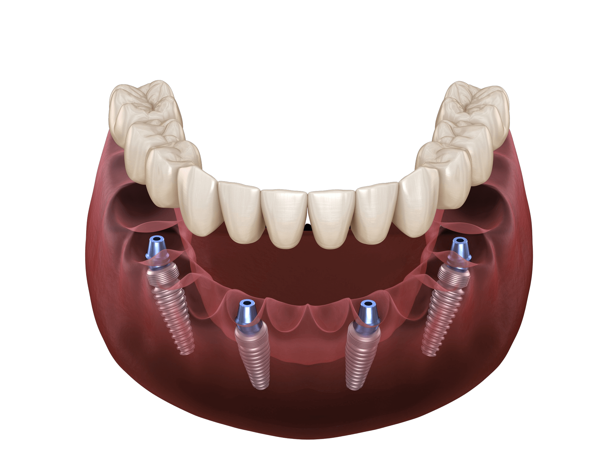 Who should not get dental implants?
