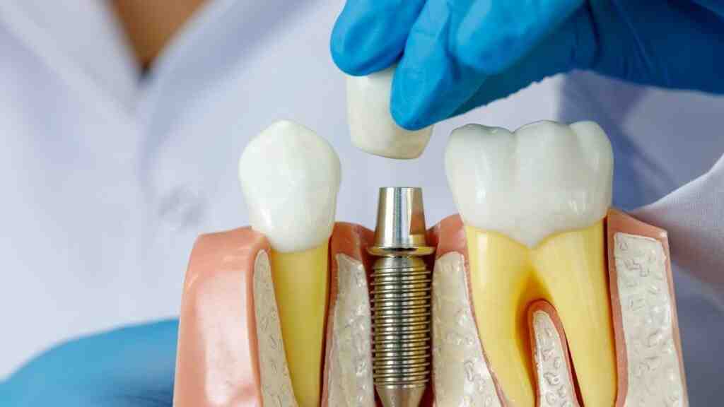 Why am I so tired after dental implants?