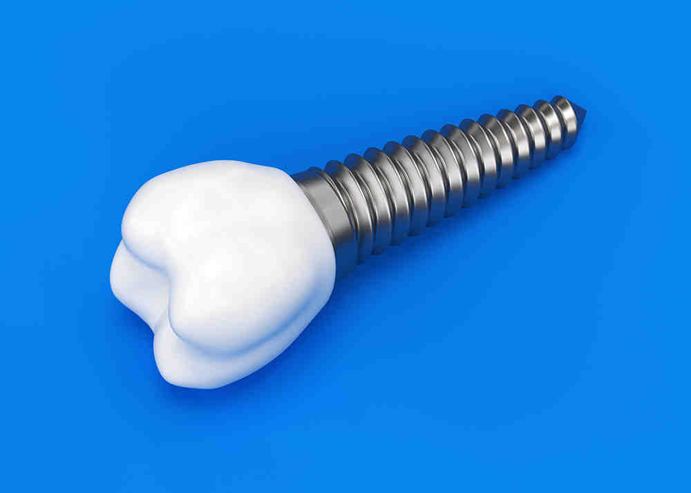 Why are implants medically necessary?