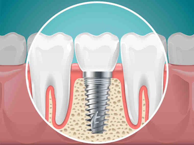 Why can't diabetics have dental implants?