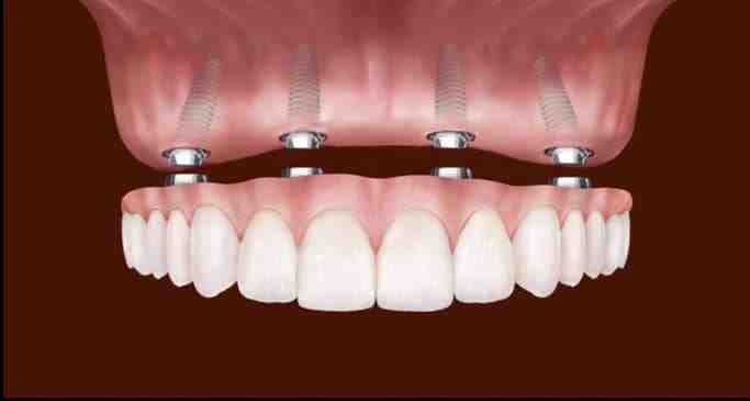 Why do gums recede around implant?