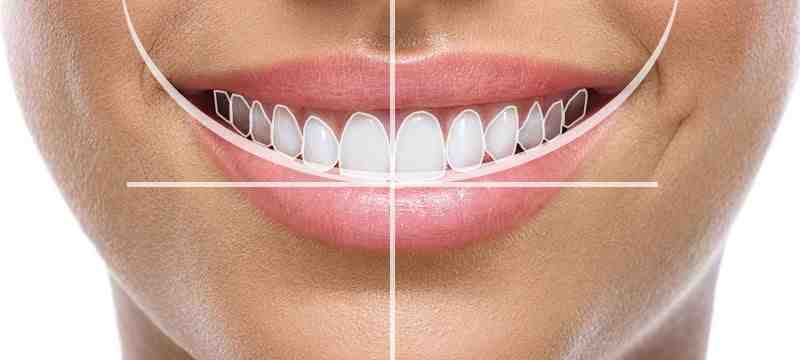 Why does half my tooth break off?