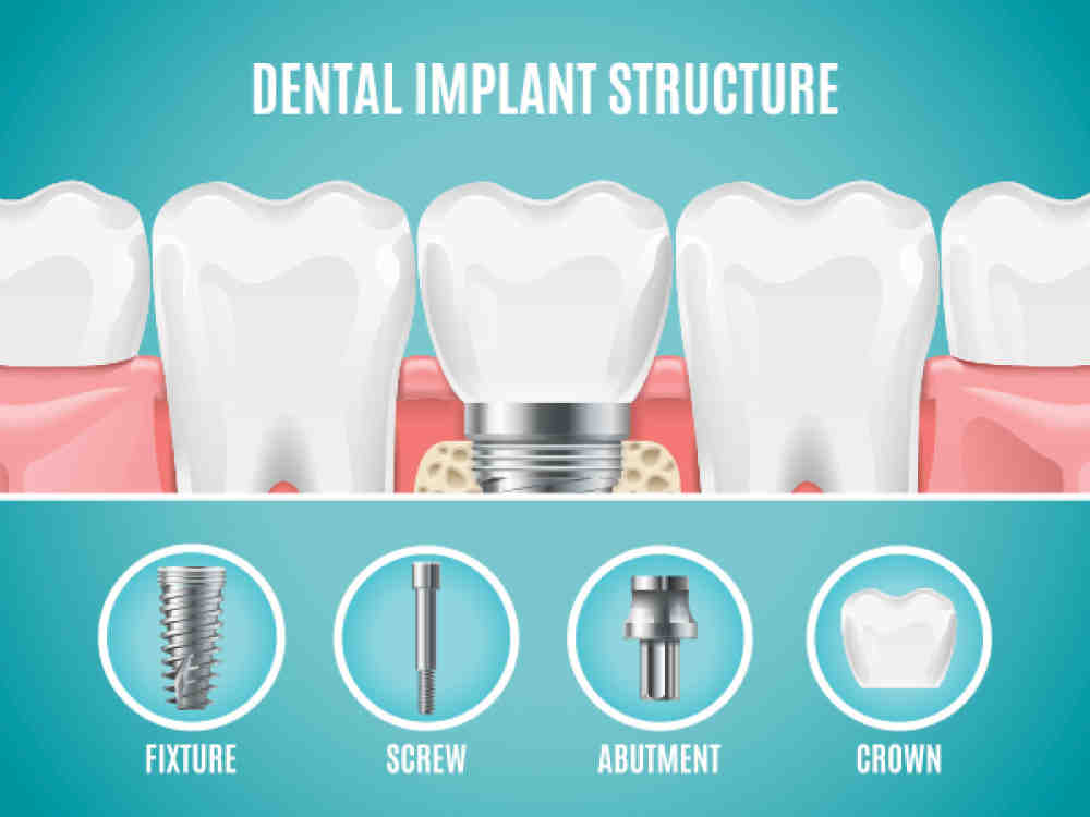 Why does my implant hurt after 2 weeks?