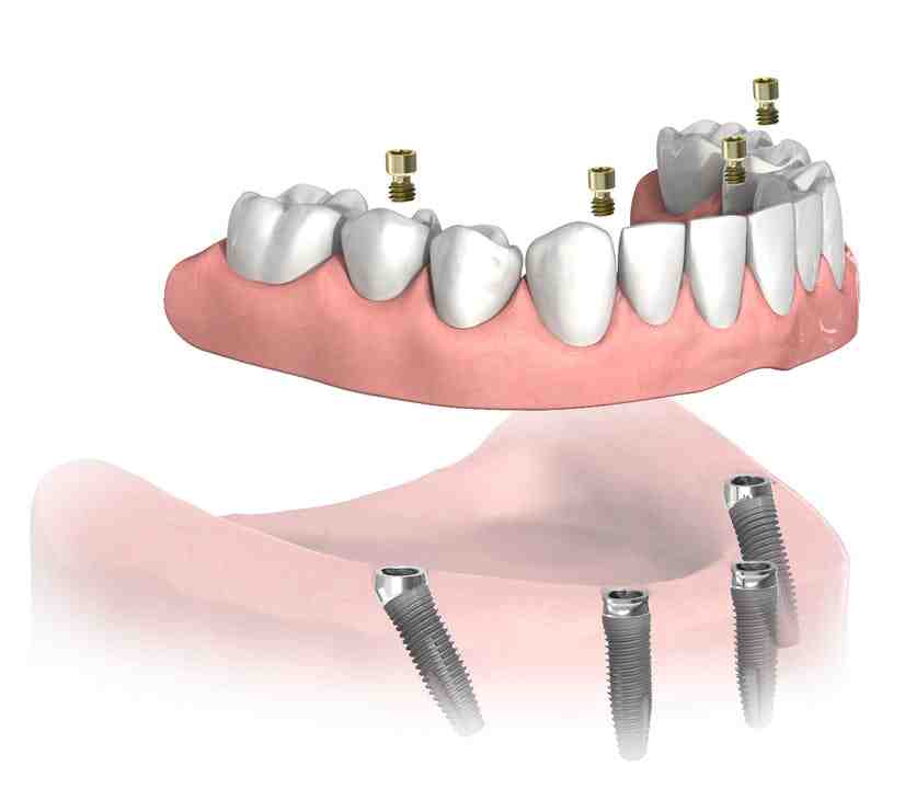 Why is titanium useful?