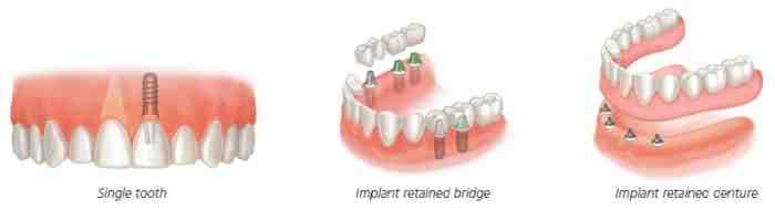 Why would a dentist recommend a partial rather than implants?