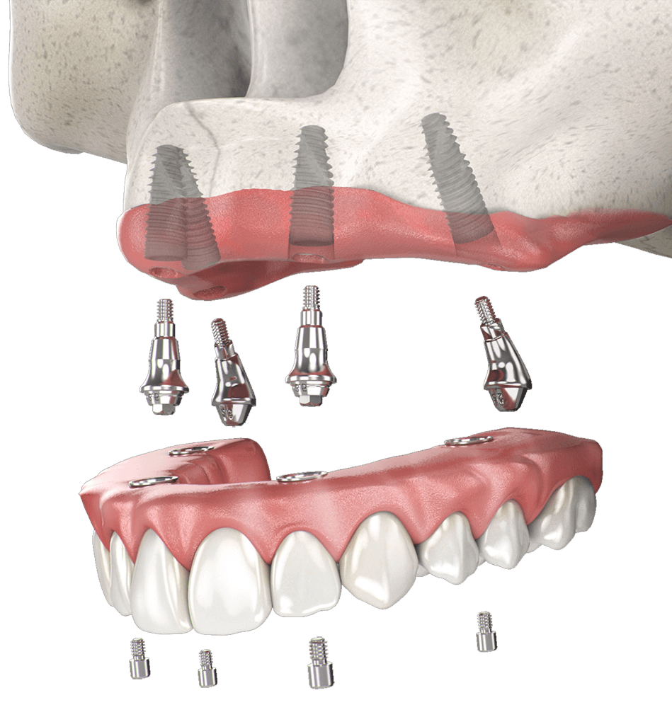Will coffee stain dental implants?