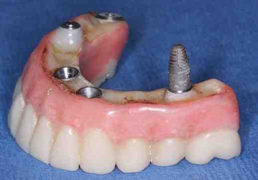 Are all on four implants removable?
