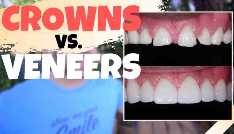 Are crowns or veneers better?