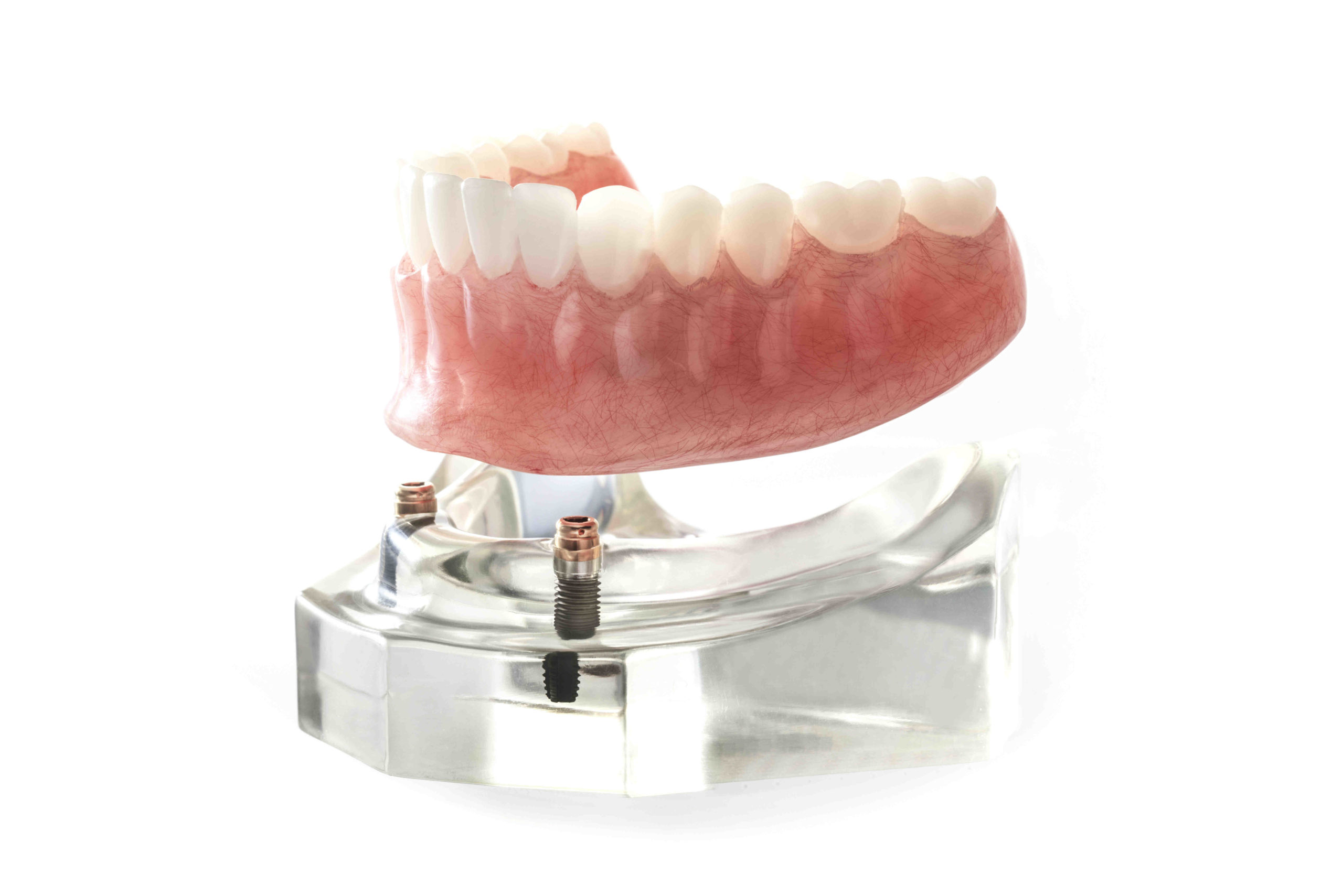 Are snap on dentures the same as implants?