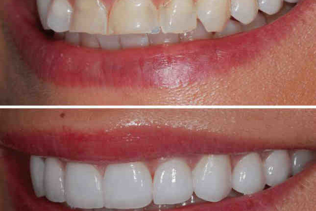 Are teeth veneers worth it?