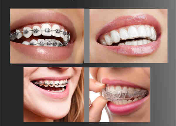 Are veneers better than Invisalign?
