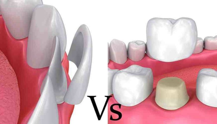 Are veneers better than implants?