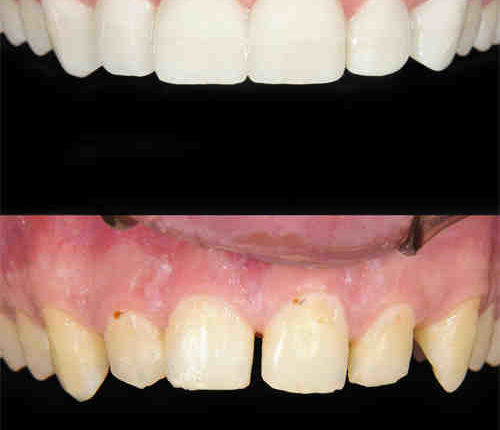 Are veneers painful?