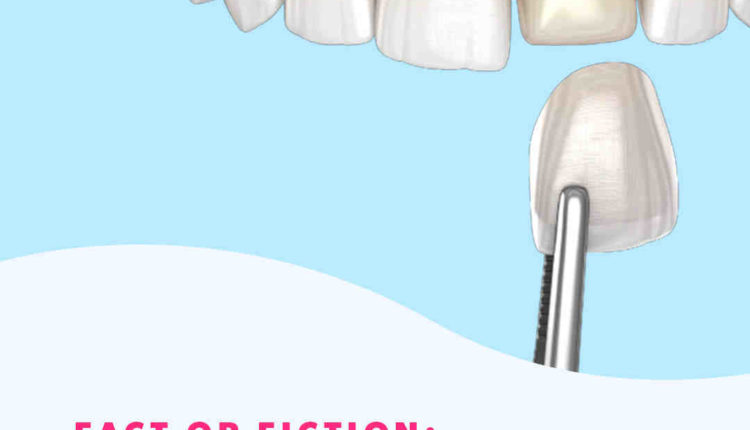 Are veneers permanent?